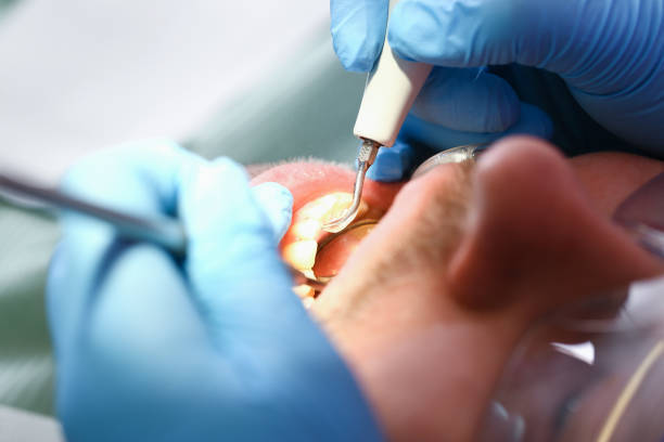 Best Emergency Gum Treatment in Geneva, NY
